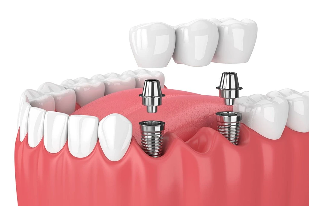 Dental Implants