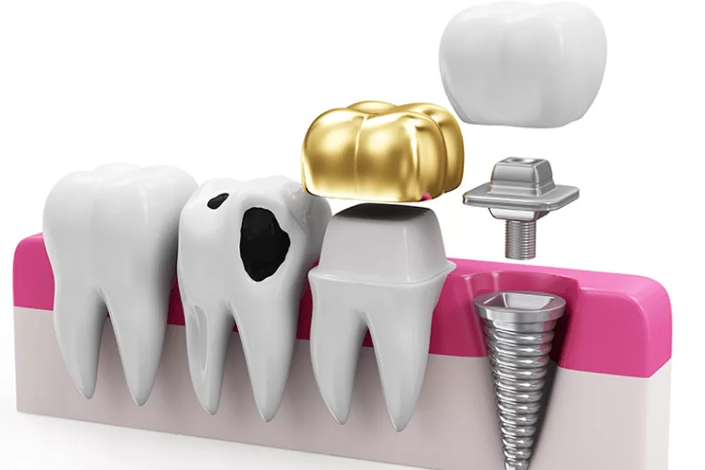Restorative Dentistry